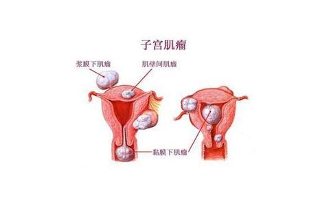 子宫肌瘤怎么治疗?子宫肌瘤会恶变吗?