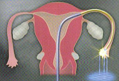 必康网科普：输卵管造影术