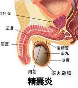 西安男性精囊炎是如何造成的？