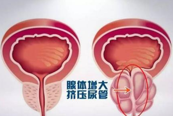 锦江人民医院看前列腺增生怎么样