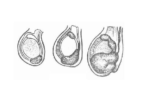 附睾结核是怎么引起的？附睾结核有哪些临床表现？