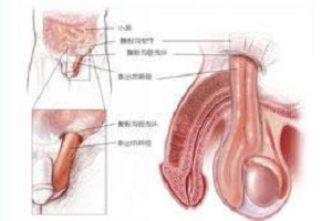 睾丸鞘膜积液手术是怎么做的？需要做什么预防措施？