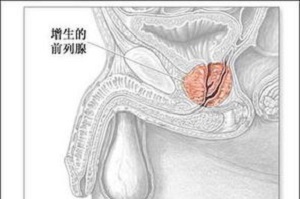 男性前列腺结石怎么防止恶化？前列腺结石怎么治疗？