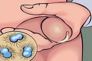 男人尿道发痒最可能是什么病？