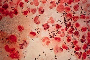 什么是霉菌性前列腺炎？它的症状有哪些？